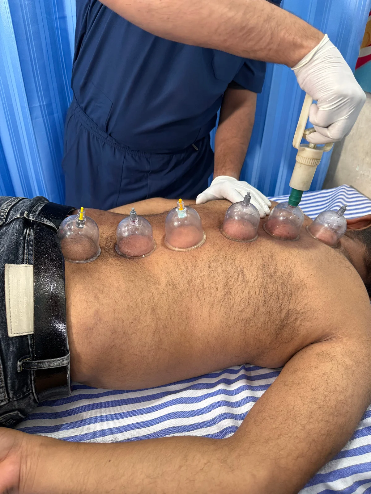 Cupping Therapy in Jaipur